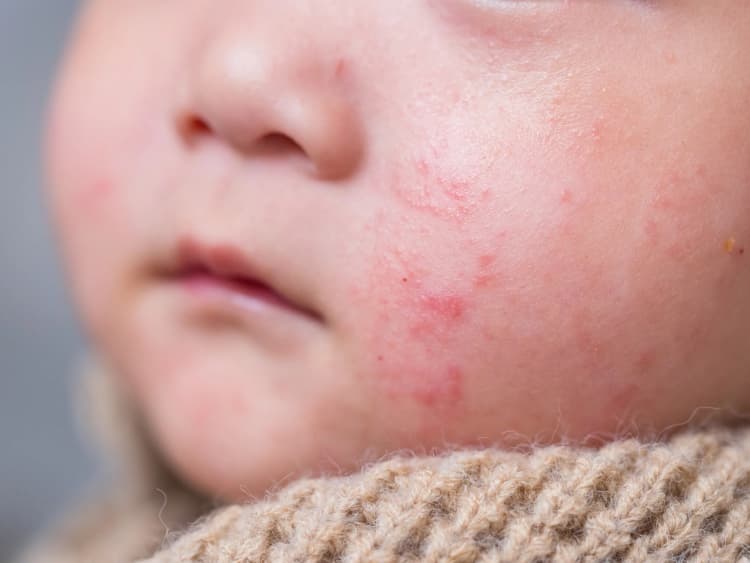 Skin Conditions
