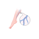 Varicose veins