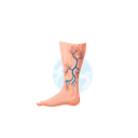 Spider Veins