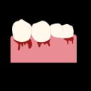 a common sign of gum inflammation or gingivitis"