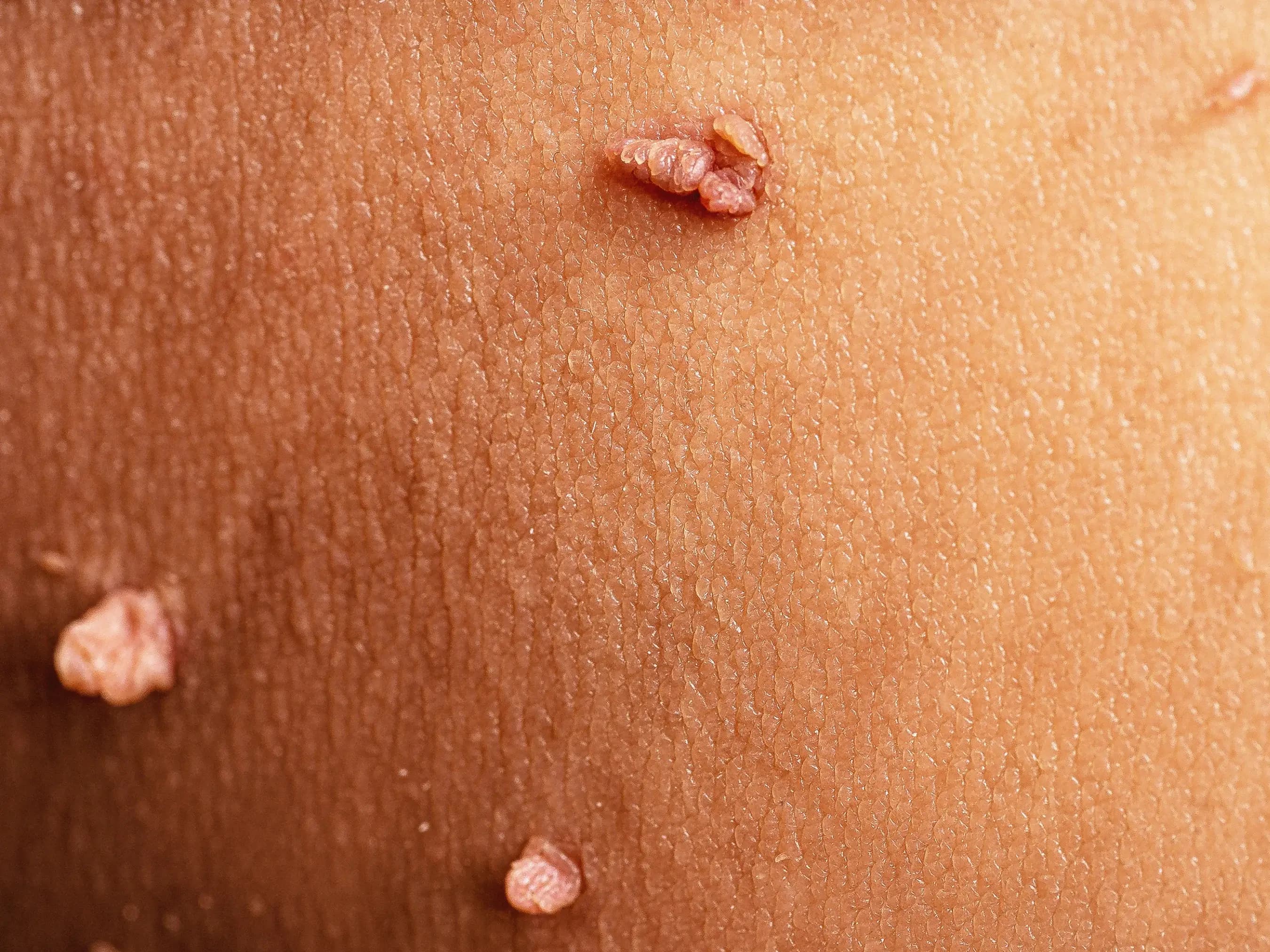 Skin Tags In Pregnancy