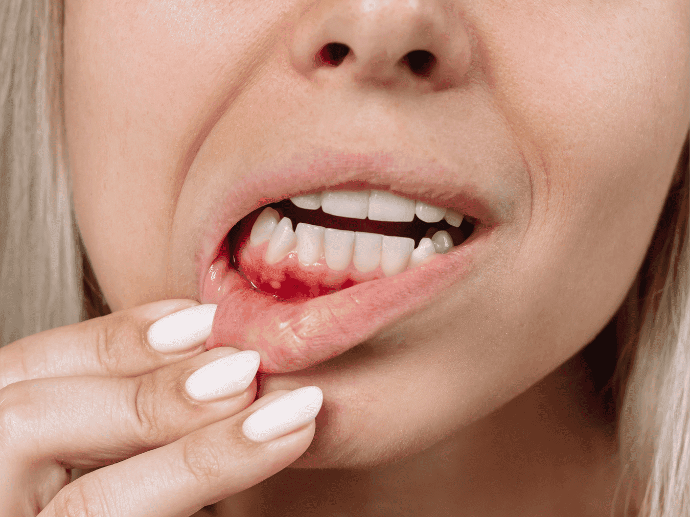 Pregnancy Gingivitis